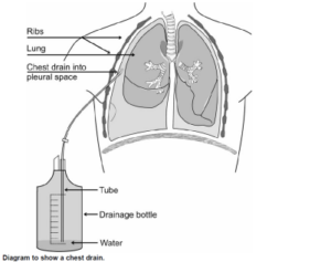 Insertion of a Chest Drain - North Tees and Hartlepool NHS Foundation Trust