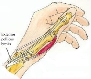 Hand Therapy - Extensor Tendon Thumb Repair - North Tees and Hartlepool ...