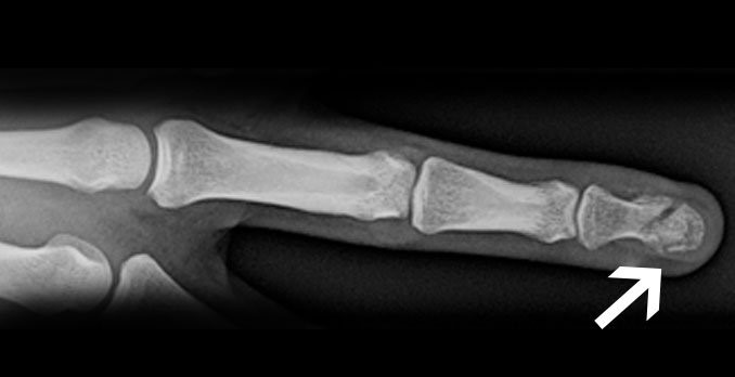 X-ray picture of a Tuft Fracture.