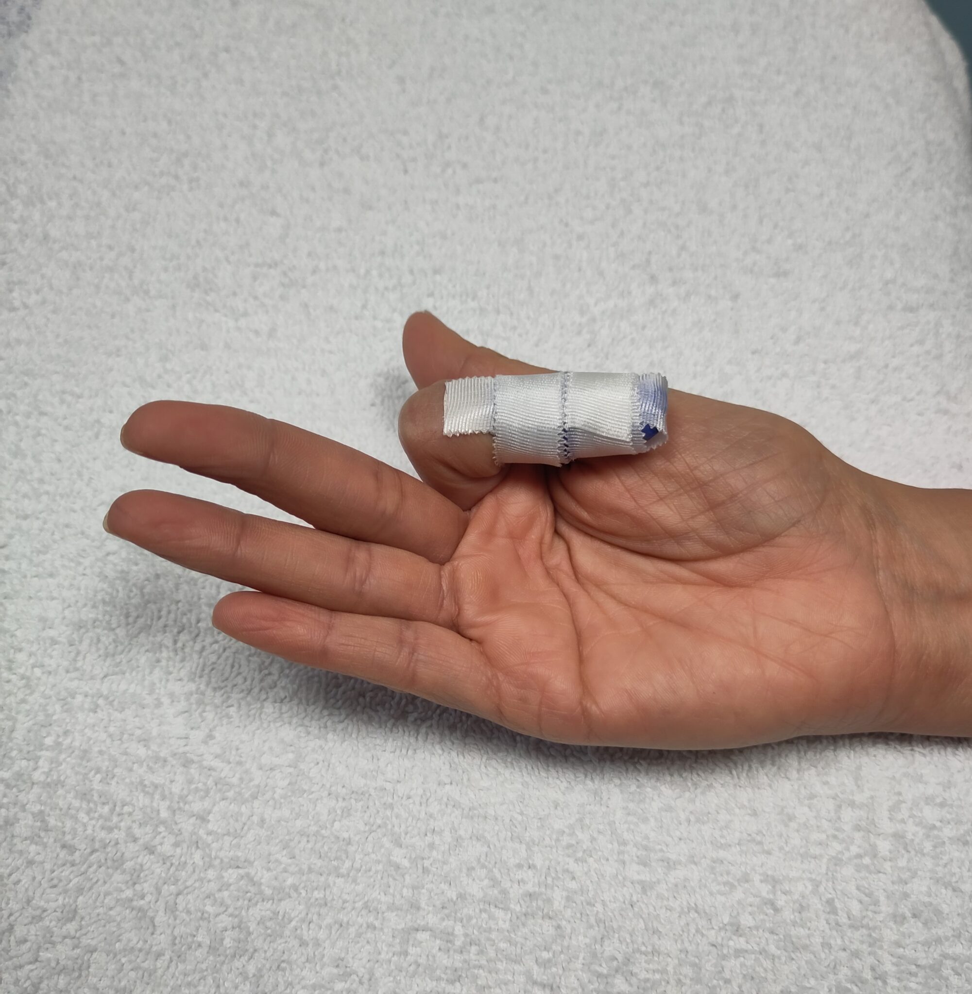 Hand Therapy - Exercises following Extensor Tendon Injury of the Finger ...